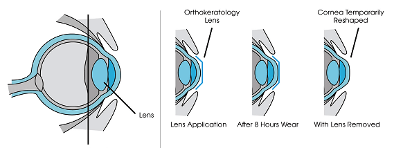 Can you have clear vision without glasses or contact lenses during the day | Eyecare on the Square Core in Cincinnati, OH